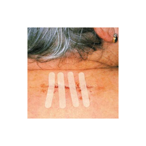 SUTURAS CUTÁNEAS ADHESIVAS Y ESTÉRILES OMNISTRIP